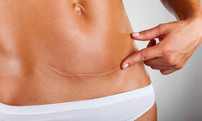 Abdominoplasty